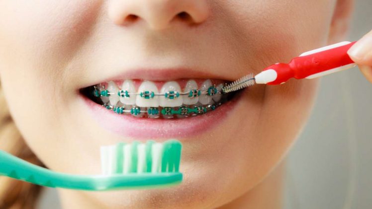 Tips to Help Children Take Care of Their Braces