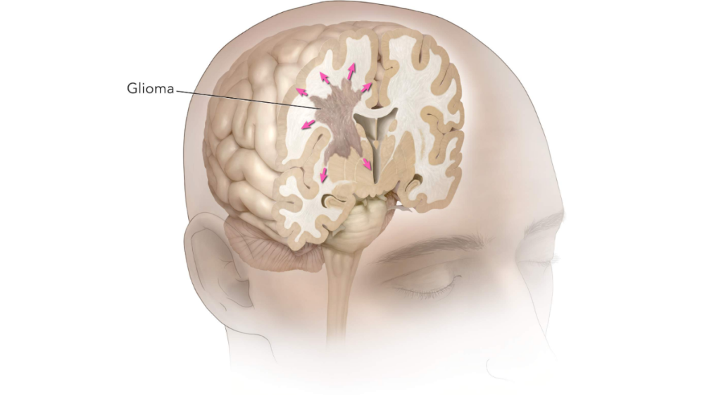 Understanding the Different Types of Gliomas and Their Treatment Options