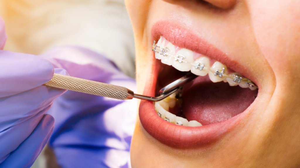 Understanding the Cost of Removing Braces