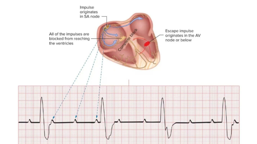 What Is SVT, AVNRT, and AVRT? How are They Shown in Resting ECG?